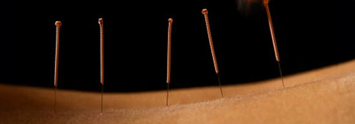 Chiropractic Towson MD Dry Needling On Back